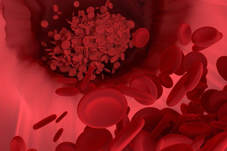 脂質異常症のイメージ画像