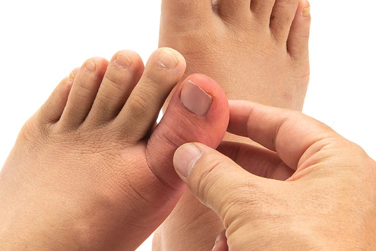 高尿酸血症（痛風）のイメージ画像